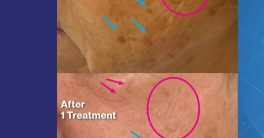 "Erase Dark Spots: Uncover Radiant Skin Secrets!"  Fraxel laser treatment, skin rejuvenation solutions, hyperpigmentation therapy