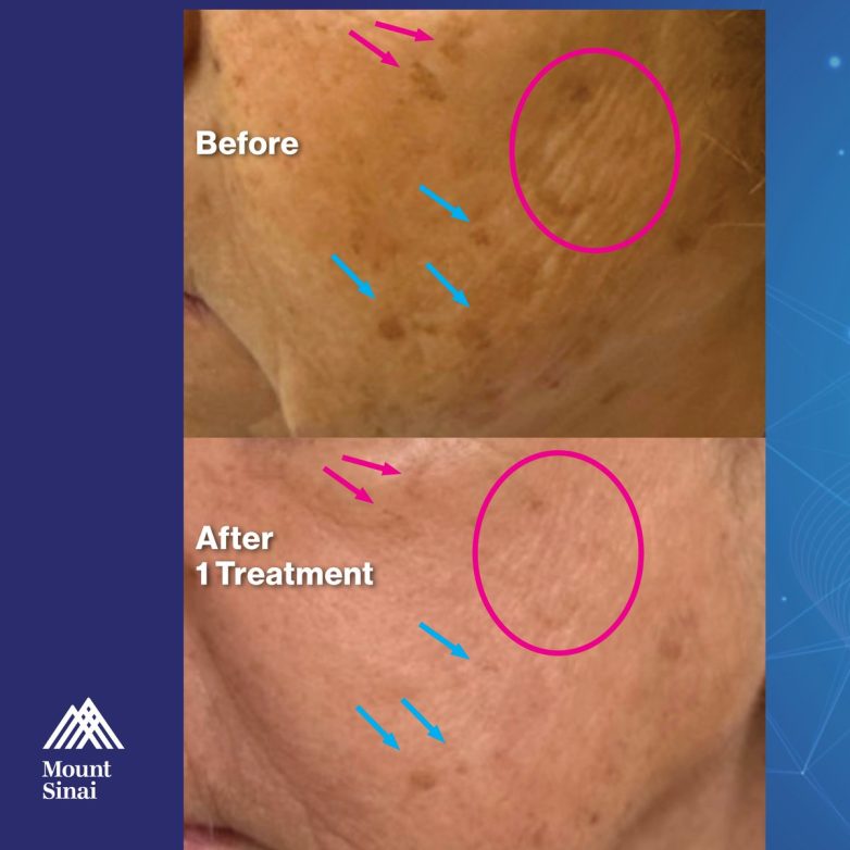 "Erase Dark Spots: Uncover Radiant Skin Secrets!" Fraxel laser treatment, skin rejuvenation solutions, hyperpigmentation therapy